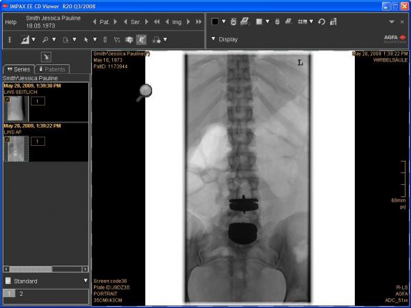 Anterior xray