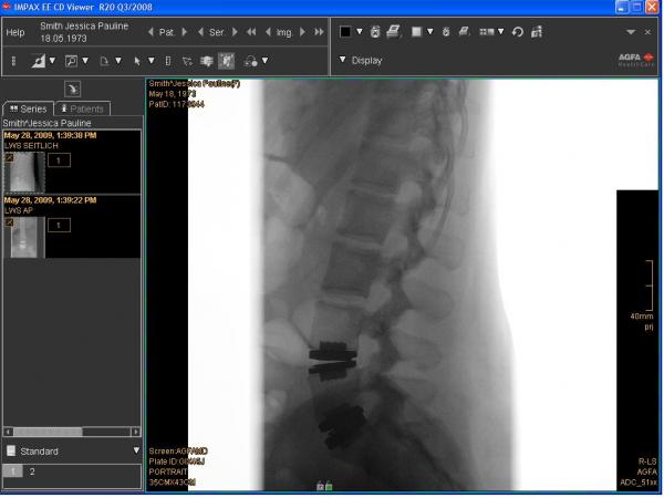 Side xray