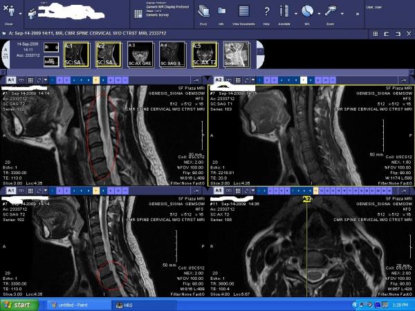 CervicalMRI